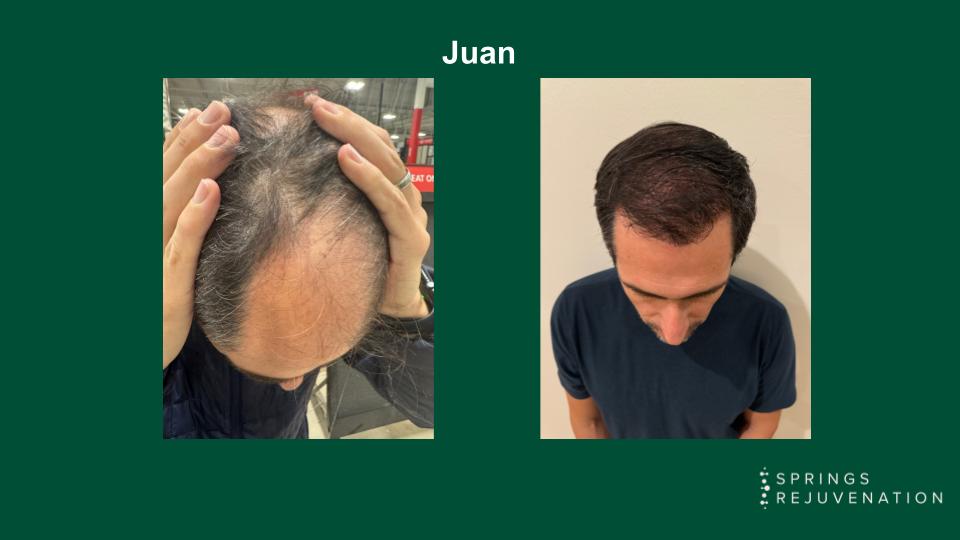 Exosome Hair Restoration Results